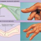 Правильное лечение деформирующего артроза кистей рук