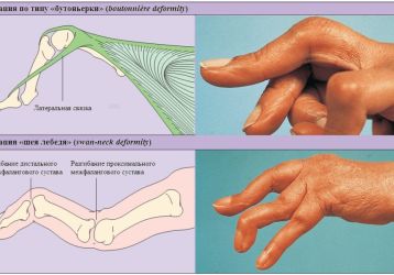 Правильное лечение деформирующего артроза кистей рук