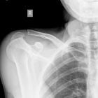 Вывих ключицы — симптомы травмы и методы лечения