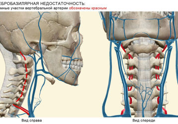 Вертебро-базилярная недостаточность на фоне шейного остеохондроза: симптомы и лечение