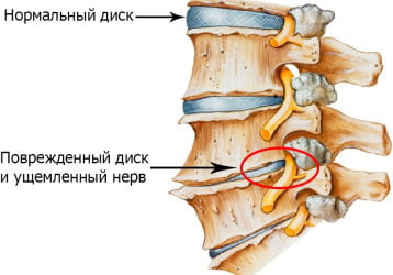 Лечение солью остеохондроза: лучшие рецепты компрессов, мазей, целебные соляные ванны