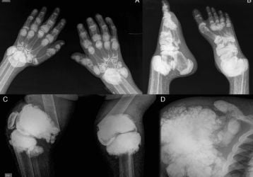 Лечение отложения солей в стопе: причины, лечение и профилактика