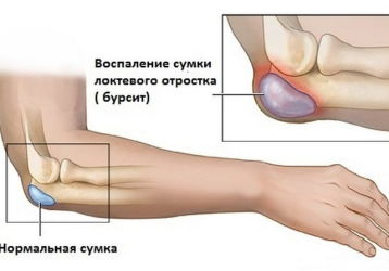 Бурсит локтевого сустава — симптомы и лечение, причины возникновения