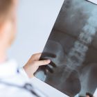 Спондилит — что это: симптомы, диагностика и способы лечения