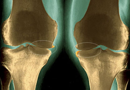 Польза зарядки при артрозе коленного сустава: правила выполнения