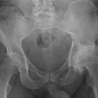 Лечение ДОА — деформирующего остеоартроза тазобедренного сустава 2 степени