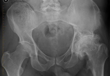 Эндопротезирование тазобедренного сустава в Москве: клиники и цены