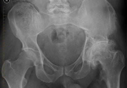 Эндопротезирование тазобедренного сустава в Москве: клиники и цены