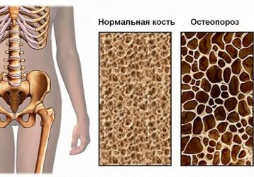 Питание и диета при остеопорозе у женщин и мужчин: что можно и что нельзя есть
