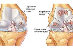 Что такое хондропатия коленного сустава: основные методы диагностики и лечения