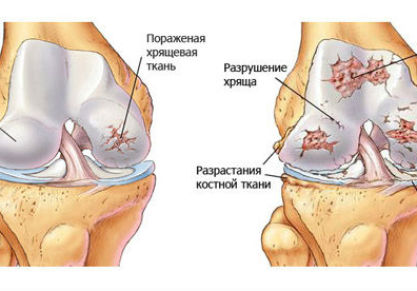 Что такое хондропатия коленного сустава: основные методы диагностики и лечения