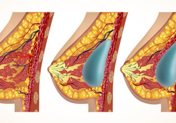 Что такое капсулярная контрактура — признаки, причины, лечение