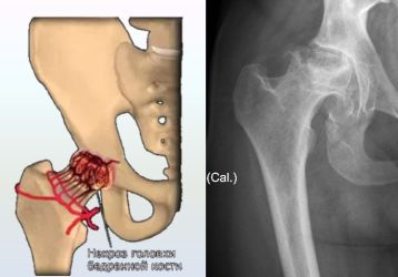 Причины боли в тазобедренном суставе, отдающей в ногу: симптомы заболеваний, лечение