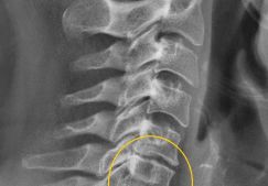Мануальная терапия при остеохондрозе шейного отдела: показания и противопоказания к применению
