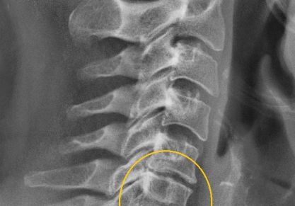Особенности медикаментозного лечения хондроза: основные группы эффективных лекарств