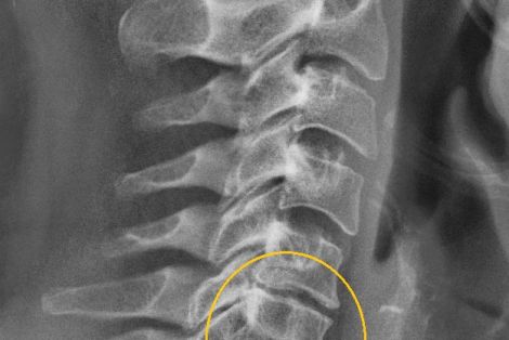 Как лечить остеохондроз шейного отдела позвоночника в домашних условиях