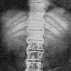 Особенности лечения болезни Бехтерева у мужчин