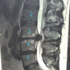 Упражнения при грыже поясничного отдела позвоночника