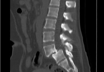 Лечение спондилолистеза поясничного и шейного отделов позвоночника