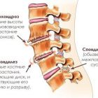 Деформирующий спондилез поясничного отдела позвоночника: симптомы и лечение