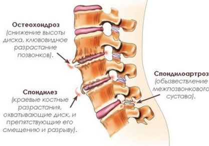 Деформирующий спондилез поясничного отдела позвоночника: симптомы и лечение