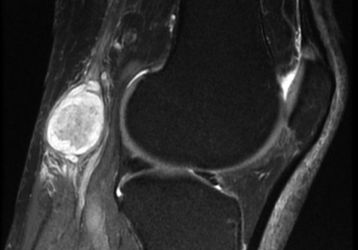 Киста в коленном суставе: лечение, симптомы, диагностика, виды кисты