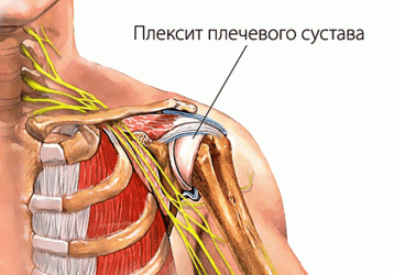 Плексит плечевого сустава: симптомы, лечение, диагностика