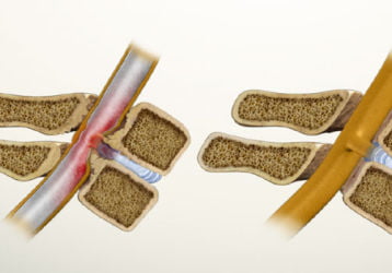 Стеноз позвоночного канала: описание, лечение, упражнения