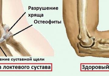 Артроз локтевого сустава: причины, симптомы, лечение, диагностика, полное описание болезни