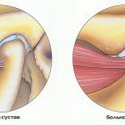 Височный тендинит: причины, симптомы и лечение