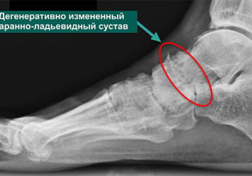 Деформирующий артроз стопы: лечение мелких суставов ног. Профилактика и питание.