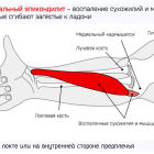 Медиальный эпикондилит локтевого сустава: что такое и как лечить