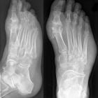 Артроз большого пальца ноги: этиология, клиническая симптоматика, тактика лечения