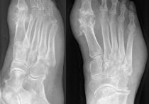 Артрит суставов стопы: симптомы, причины, как лечить заболевание