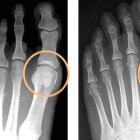 Артрит пальцев ног: симптомы и способы лечения