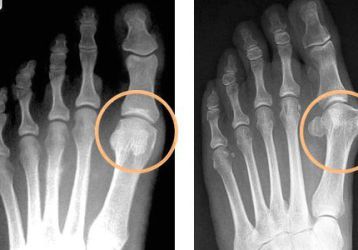 Артрит пальцев ног: симптомы и способы лечения