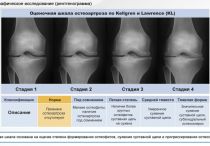 Гонартроз 2 степени: причины, симптомы, методы лечения
