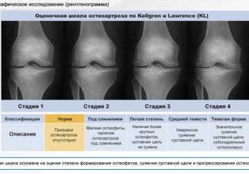 Гонартроз 2 степени: причины, симптомы, методы лечения