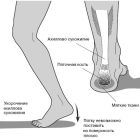 Бурсит стопы — причины, симптомы и методы лечения