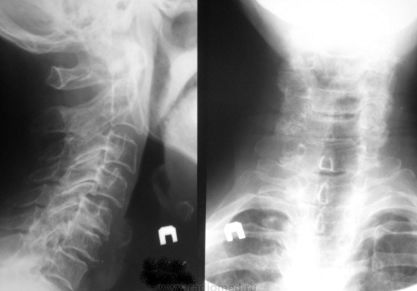 ВСД и шейный остеохондроз — симптомы, лечение