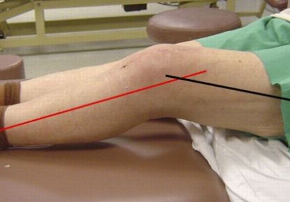 Восстановление после травмы коленного сустава: инструкция и правила реабилитации