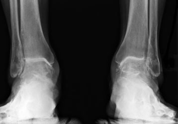 Эндопротезирование голеностопного сустава: показания, операция и реабилитация