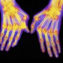 Оценка риска ревматоидного артрита