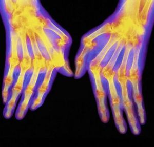 Оценка риска ревматоидного артрита