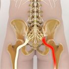Защемление нерва в тазобедренном суставе: причины, симптомы и лечение ущемления