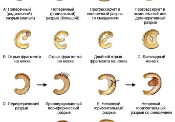Разрыв мениска коленного сустава: причины травмы, симптомы, диагностика и методы лечения