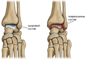 Деформирующий остеоартроз голеностопного сустава: 1-2 степени
