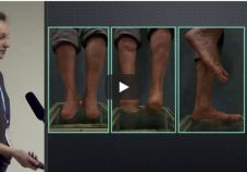 Видео доклад: плоскостопие, факты о заболевании. Е.А. Мирошникова (Москва)