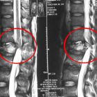 Туберкулез костей, суставов и позвоночника: у кого развивается и чем опасен