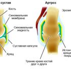 Артрозо-артрит коленного, тазобедренного, голеностопного и плечевого суставов